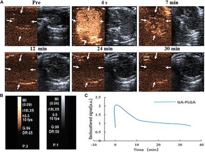 Effect of Gambogic Acid–Loaded Porous-Lipid/PLGA Microbubbles in Combination With Ultrasound-Triggered Microbubble Destruction on Human Glioma